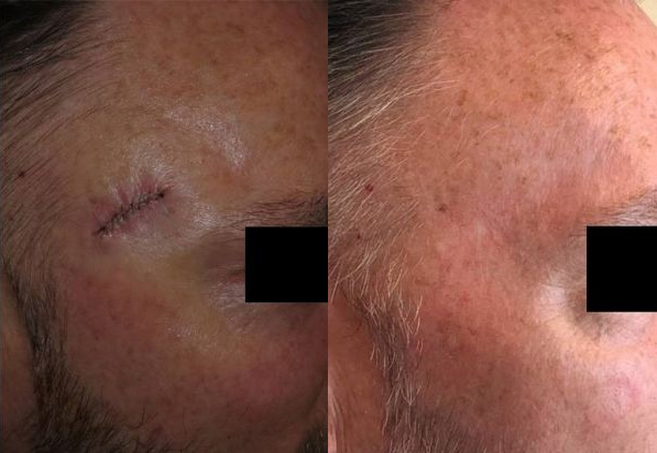 Mohs Scar Before and After