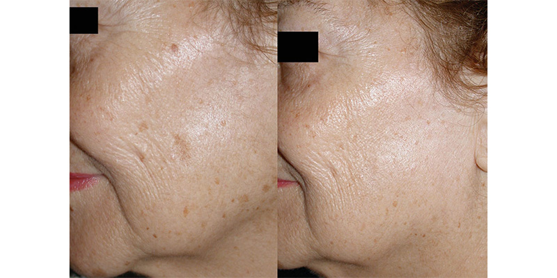 Resurface-Lasers IPL Before/After